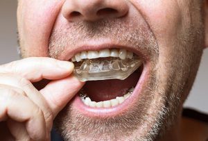 from https://www.webmd.com/oral-health/ss/slideshow-tmj-tmd-overview