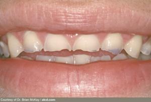 from https://www.webmd.com/oral-health/healthy-teeth-17/slideshow-enamel-erosion