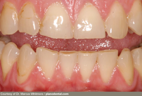 from https://www.webmd.com/oral-health/healthy-teeth-17/slideshow-enamel-erosion