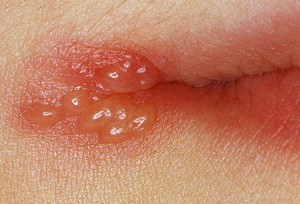 from https://www.webmd.com/skin-problems-and-treatments/ss/slideshow-cold-sores