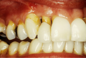 from https://www.webmd.com/oral-health/ss/slideshow-sensitive-teeth-causes