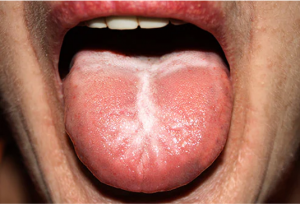 from https://www.webmd.com/oral-health/ss/slideshow-tongue-your-health