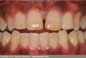 from https://www.webmd.com/oral-health/ss/slideshow-teeth-gums