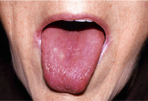from https://www.webmd.com/oral-health/ss/slideshow-tongue-your-health