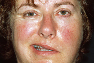 from https://www.webmd.com/skin-problems-and-treatments/ss/slideshow-face-your-health