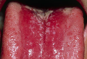 from https://www.webmd.com/oral-health/ss/slideshow-mouth-problems