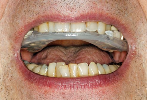 from https://www.webmd.com/oral-health/ss/visual-guide-dental-hardware