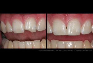 from https://www.webmd.com/oral-health/ss/slideshow-cosmetic-dentistry