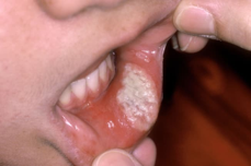 from https://www.webmd.com/oral-health/ss/slideshow-canker-sores