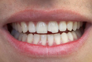 from https://www.webmd.com/oral-health/ss/slideshow-tooth-problems